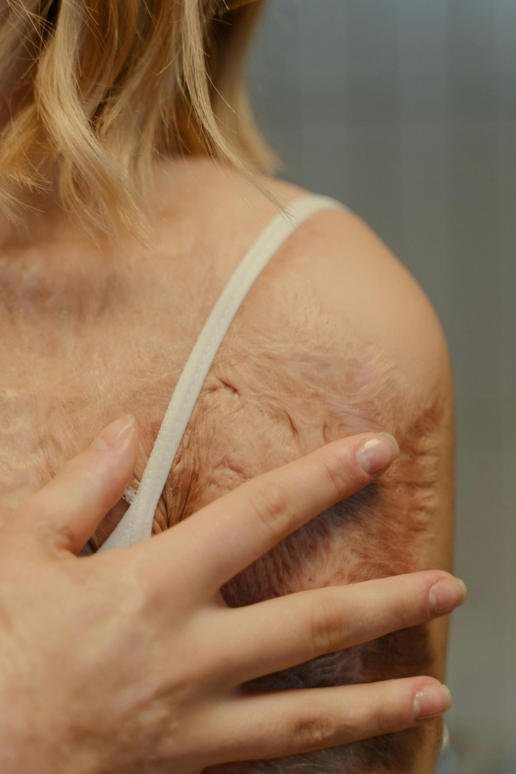 Retrouver une peau saine après traitement de la dermite séborrhéique
