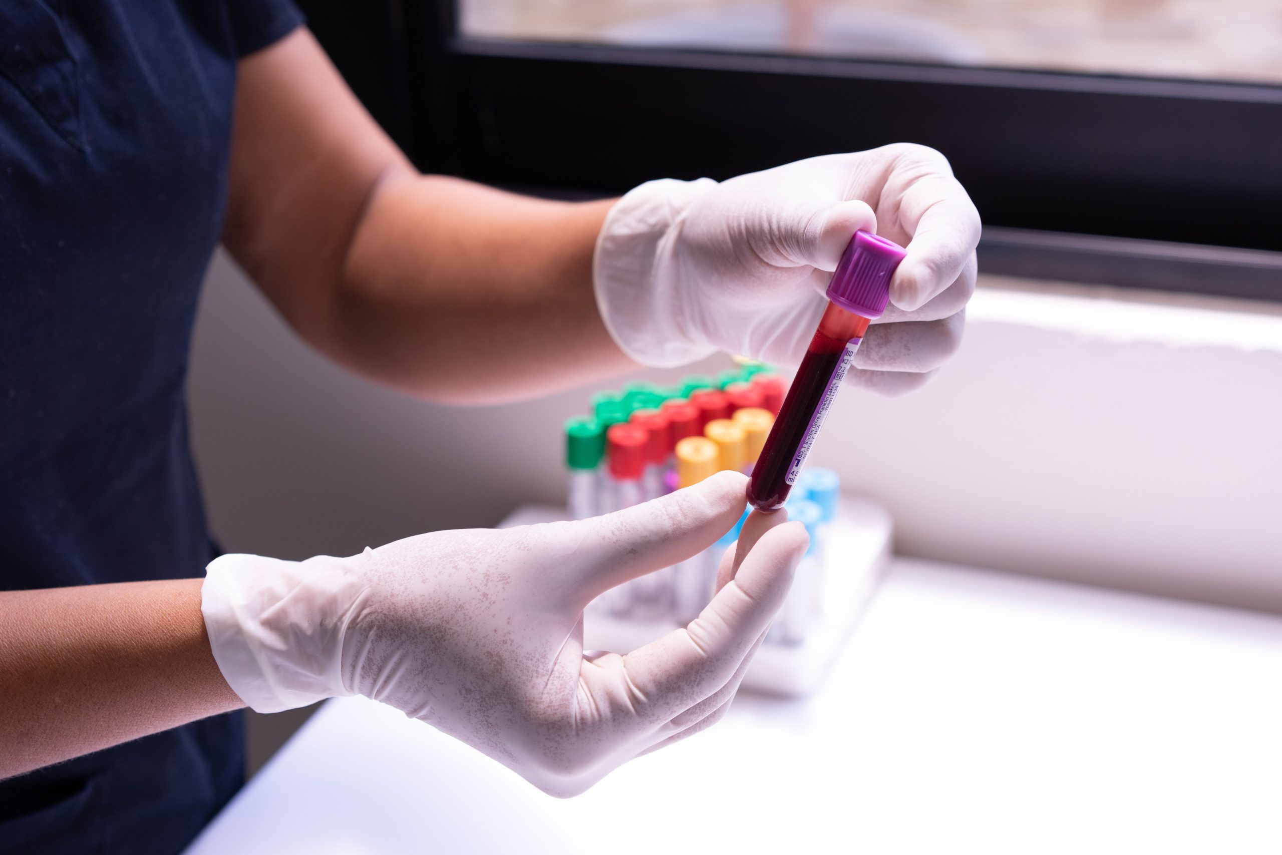 Causes symptômes et définition baisse plaquettes