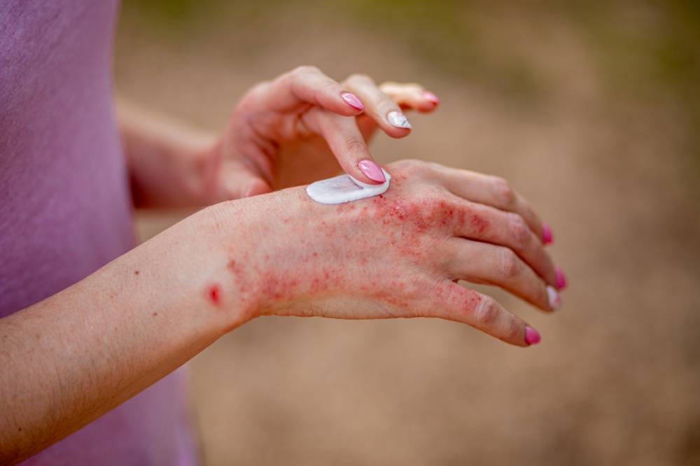 poussée psoriasis effets sur la peau