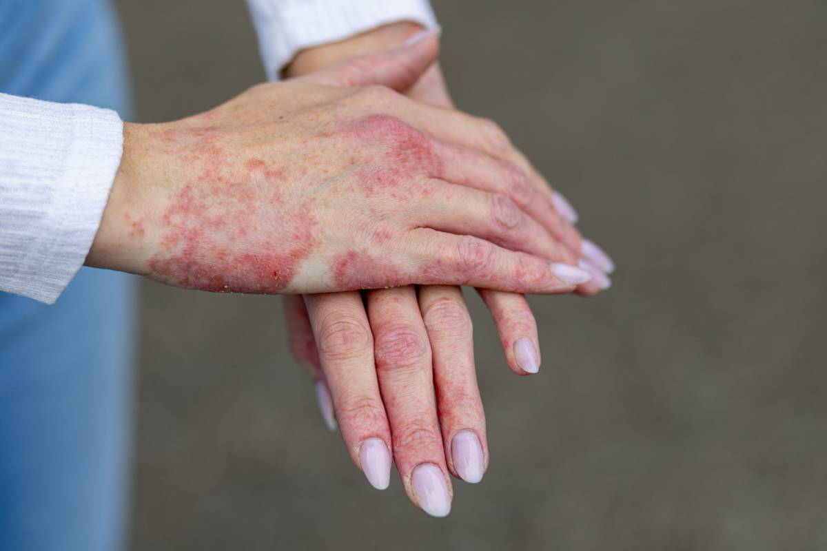 Psoriasis et peau sensible : apaiser les rougeurs